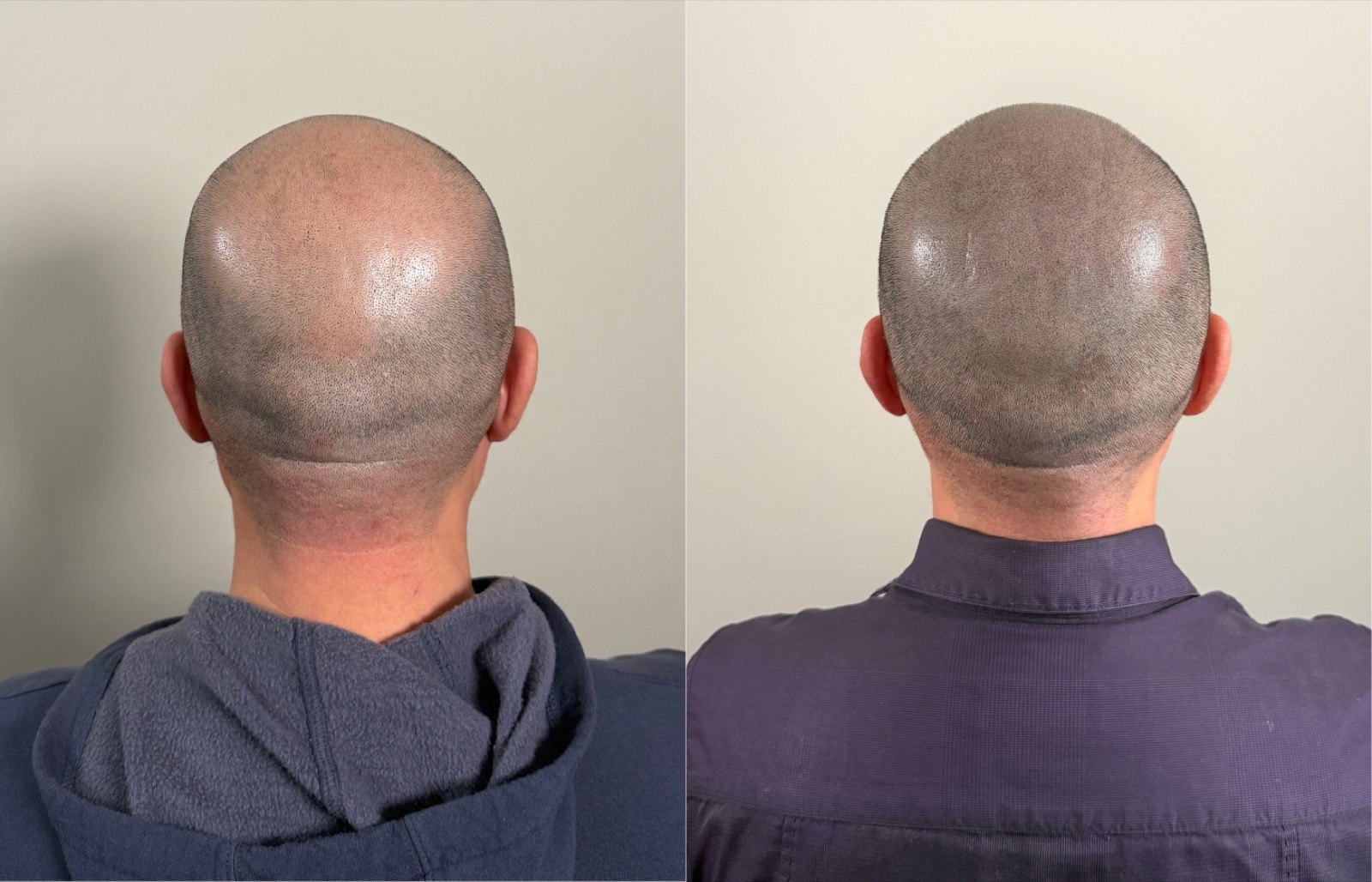 Shaved look SMP portfolio 4
